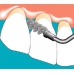 Sonicflex® clean - набор насадок и щетки Sono для профессиональной механической чистки зубов (снятия зубных отложений)